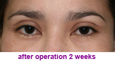 plastic-surgery-blepharoplasty